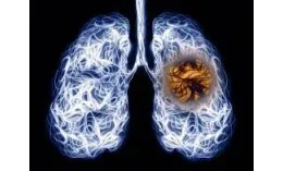 Điều trị COPD kèm di chứng do lao