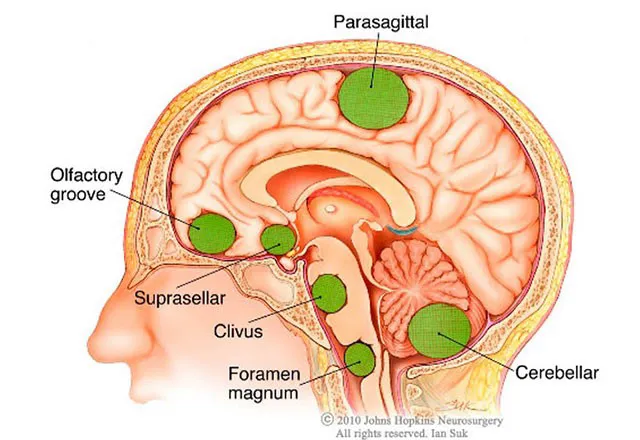 Khối u não là gì