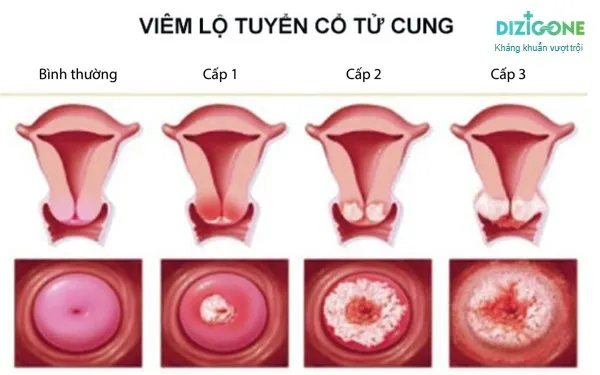 viem_lo_tuyen viêm lộ tuyến 